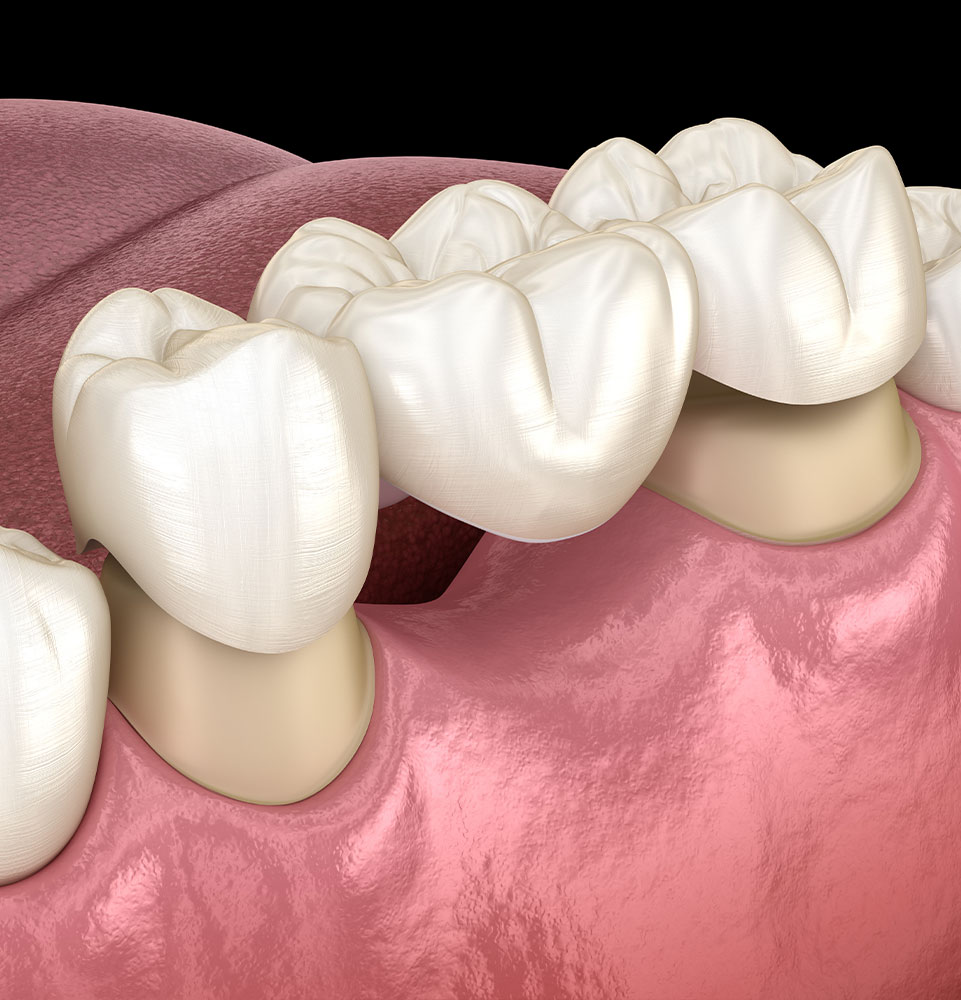 up close graphic of dental bridge