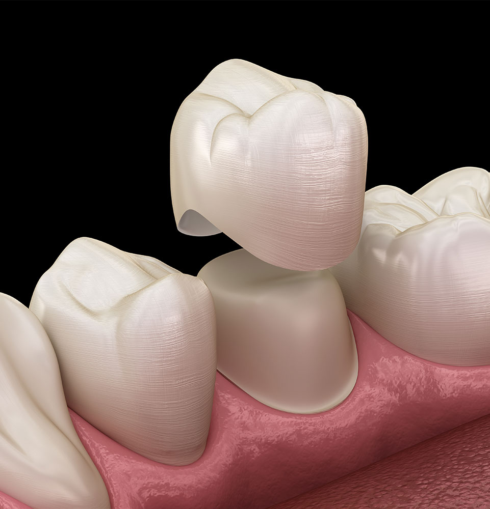 up close graphic of dental crown