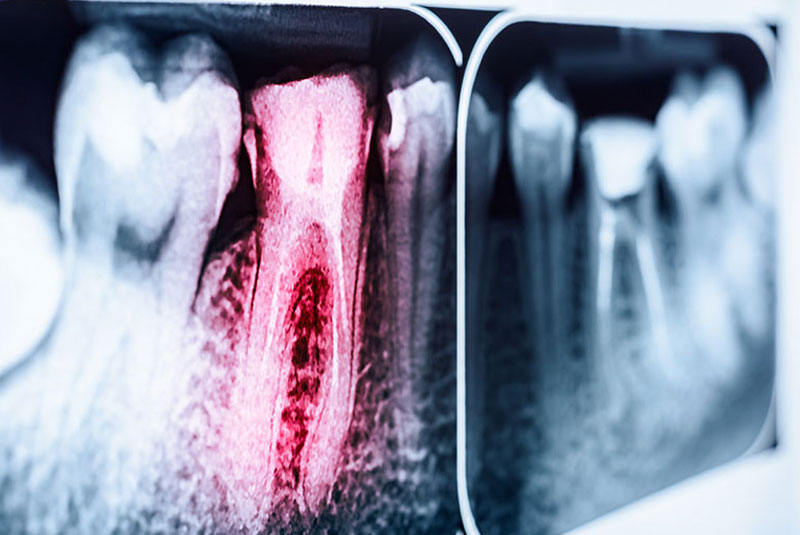 close up of x-ray root canal