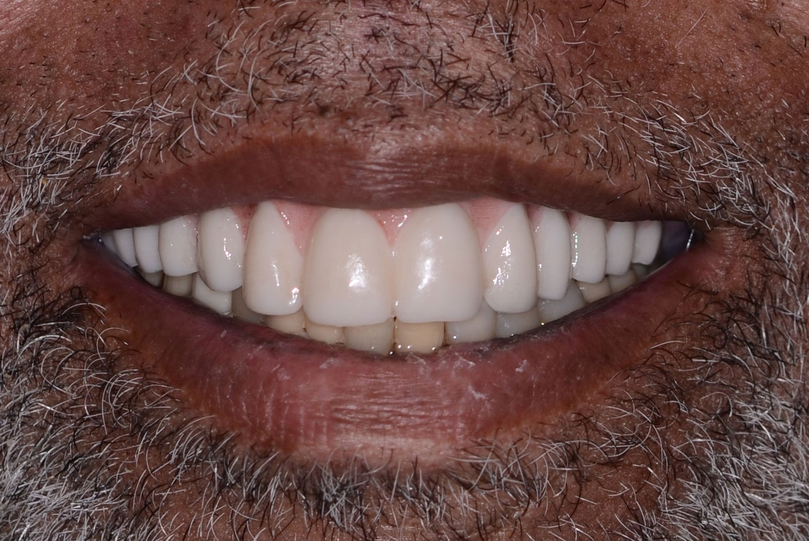 upper hybrid dentures