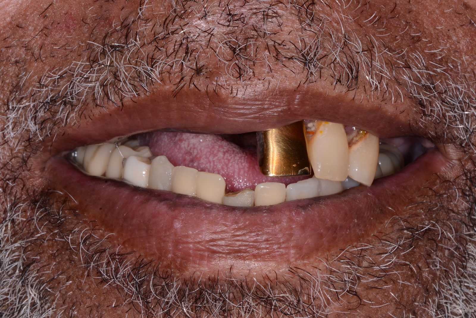 upper hybrid dentures
